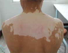 白癜风早期能康复吗?资深白癜风医生倾情详解