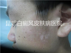 父母必读:小孩脸上有白斑是白癜风吗