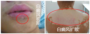 中断治疗会对白癜风病情产生哪些危害?