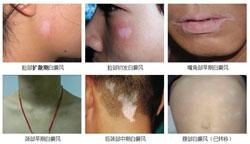 白癜风是怎样引起的?