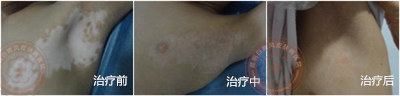 春天长白斑?综合白癜风的四大症状帮你自查