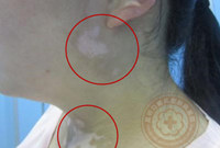 春天长白斑?综合白癜风的四大症状帮你自查