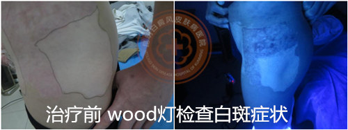 攻克白癜风治疗新高度,大小白斑同治