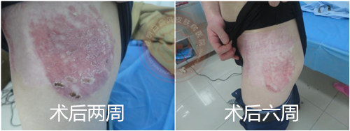 攻克白癜风治疗新高度,大小白斑同治