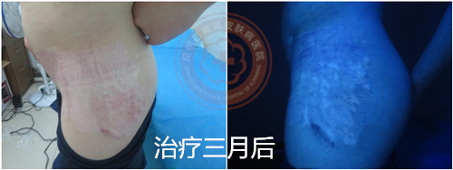 攻克白癜风治疗新高度,大小白斑同治