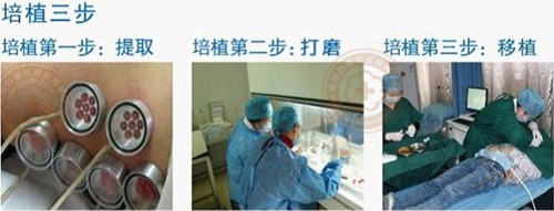 攻克白癜风治疗新高度,大小白斑同治