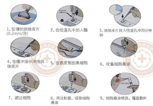 攻克白癜风治疗新高度,大小白斑同治